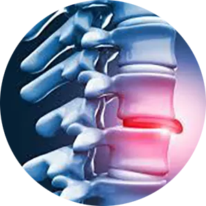 Disc Injury Treatment Chiropractor in Palm Bay, FL Near Me Chiropractor for Disc Injuries
